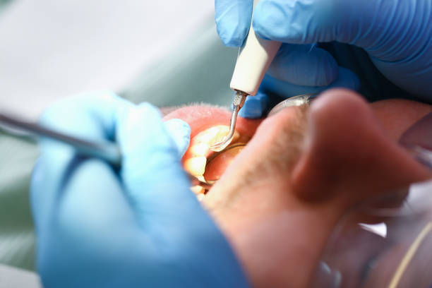 Best Urgent Care for Lost Fillings or Crowns in Angola, NY